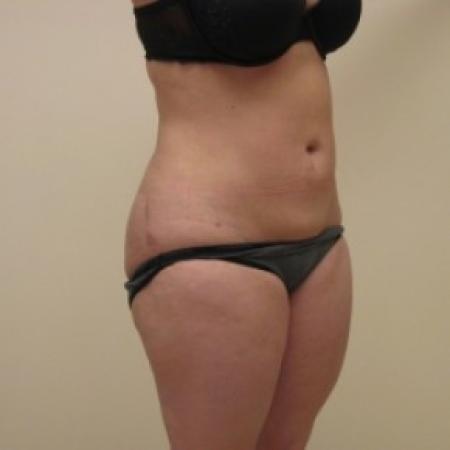 After image 2 Case #81156 - Liposuction