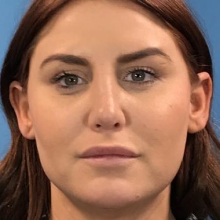 After image 1 Case #87356 - 27 year-old  -  Rhinoplasty/Septoplasty/Turbinectomy/Liposuction to Neck  -  2 months post-op