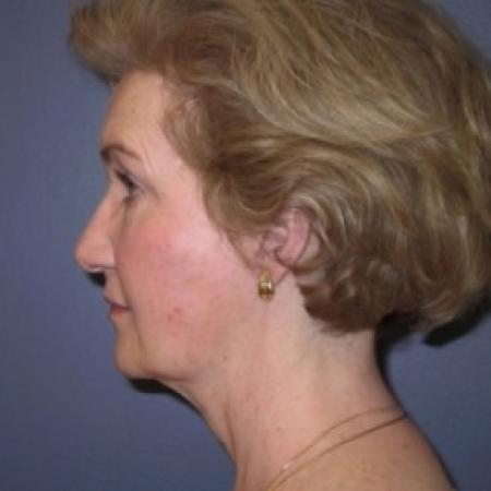 After image 3 Case #81051 - Facelift