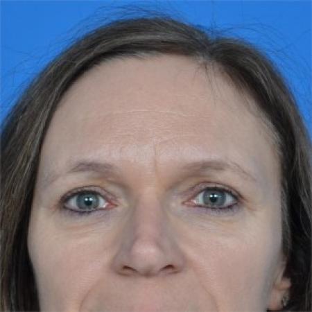 After image 1 Case #87891 - Upper Eyelid Surgery (blepharoplasty)