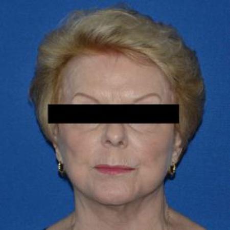 After image 1 Case #86796 - Full Facelift