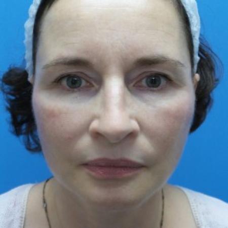 After image 1 Case #86976 - 57 year old  -  Facelift/Submental Liposuction  -  2 months post-op