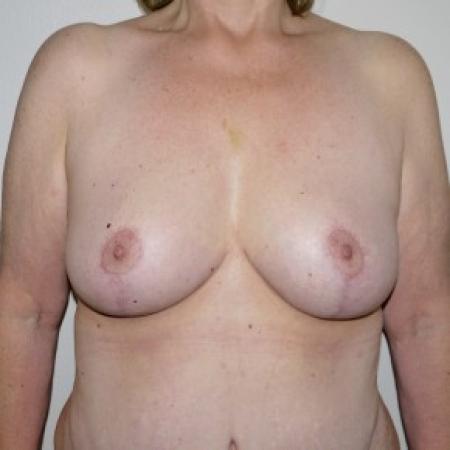 After image 1 Case #82591 - Full Mastopexy