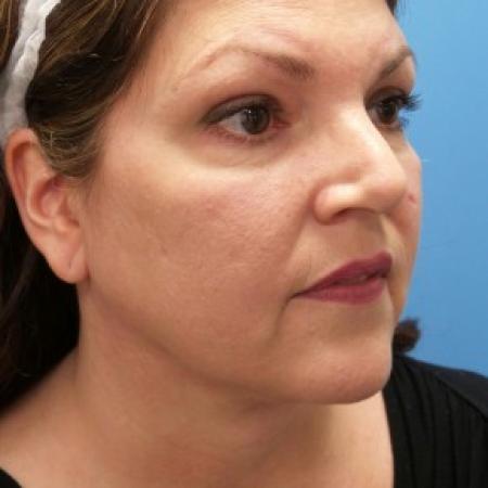 After image 1 Case #87161 - 47  year old  -  SkinTite with J-Plasma RF & Liposuction of Neck  -  2 months post-op