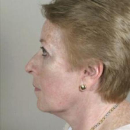 After image 1 Case #80661 - Facelift New Jersey