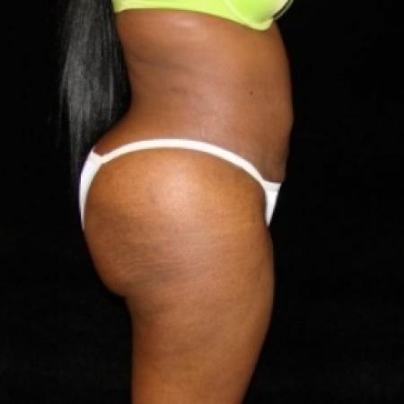 After image 3 Case #80486 - Buttocks Augmentation Via Fat Grafting with Liposuction of Abdomen, Waist, Flanks, and Dorsal Roll