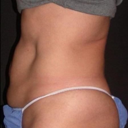 After image 2 Case #81866 - CoolSculpting