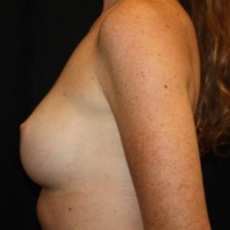 After image 3 Case #85011 - Breast Augmentation - 26 year old female