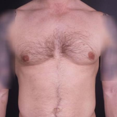 After image 1 Case #85091 - Bilateral Liposuction with Excision for Gynecomastia