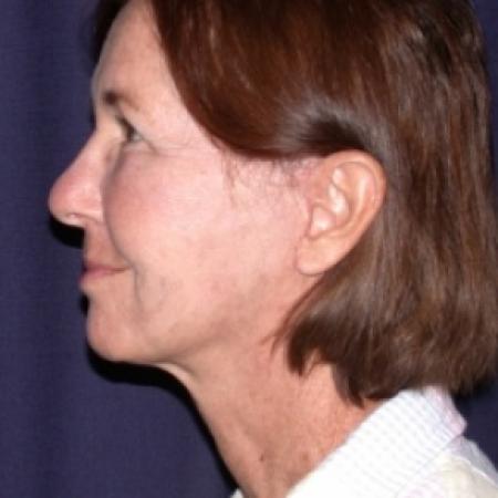 After image 3 Case #78811 - FaceLift- Minimal Access Cranial Suspension (MACS)/ Fat Grafting 