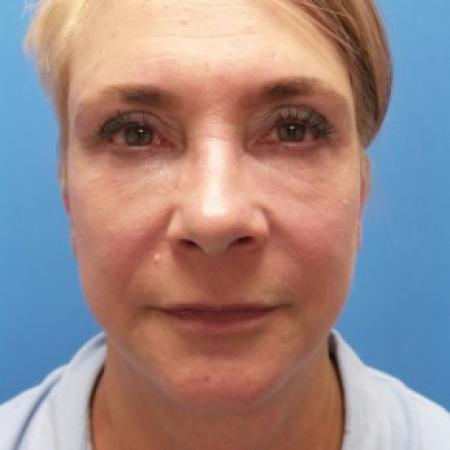 After image 1 Case #87176 - 57 year old  -  Facelift/Laser Resurfacing under eyes  -  1 year - 7 months post-op