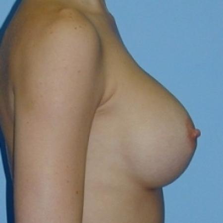 After image 2 Case #79101 - Saline Breast Implants
