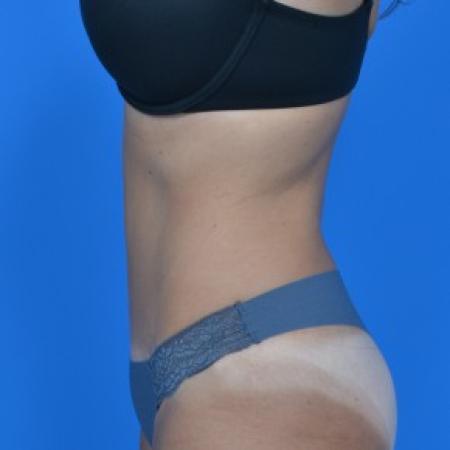 After image 3 Case #87841 - Tummy Tuck