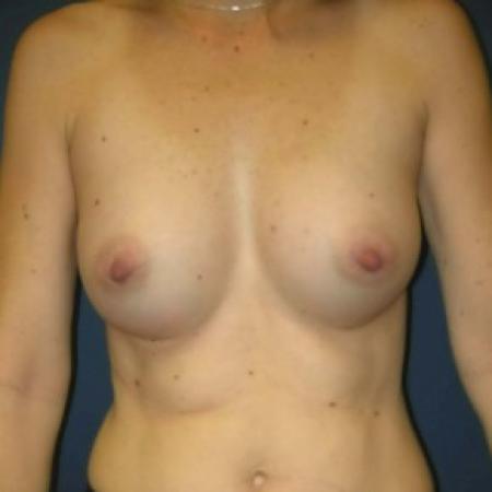 After image 1 Case #82886 - Breast Augmentation using Memory Shape Gel Implants