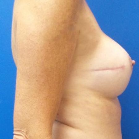 After image 3 Case #87286 - Implant Based Breast Reconstruction
