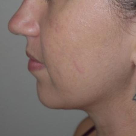 After image 1 Case #82556 - Liposuction of the chin and neck