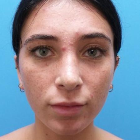 After image 1 Case #87441 - 21 year old  -  Rhinoplasty  -  6 months post-op