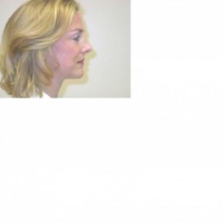 After image 2 Case #81061 - Facelift and Rhinoplasty
