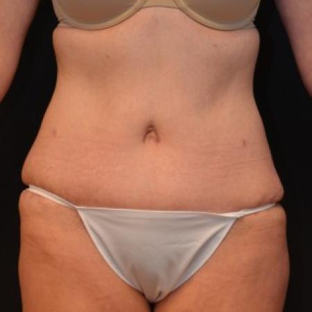 After image 1 Case #81721 - Tummy Tuck