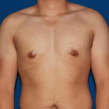 After image 1 Case #79991 - Gynecomastia male breast reduction