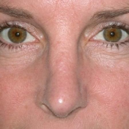 After image 1 Case #79261 - Rhinoplasty