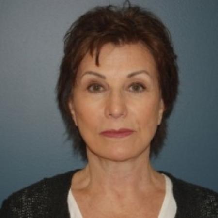 After image 1 Case #81101 - Facelift