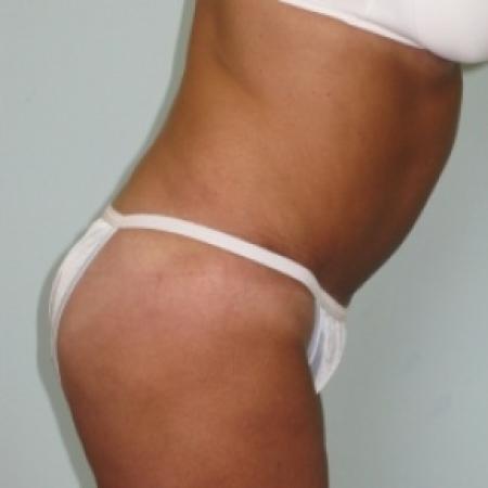 After image 2 Case #79921 - Tummy Tuck 