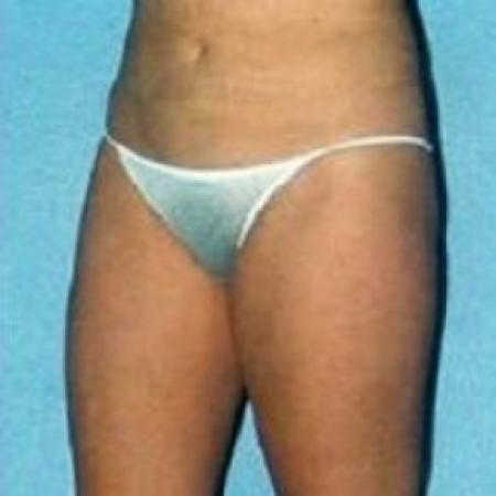 After image 3 Case #79186 - Liposuction