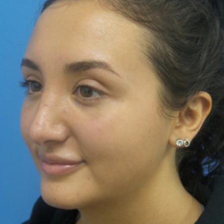 After image 2 Case #88381 - 21 year-old  -  Rhinoplasty  -  4 months post-op