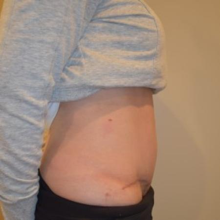 After image 2 Case #85816 - Abdominoplasty with diastasis repair