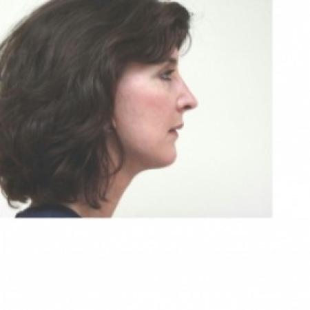 After image 2 Case #81036 - Facelift 