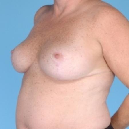 After image 2 Case #79711 - Bilateral Breast Reduction 