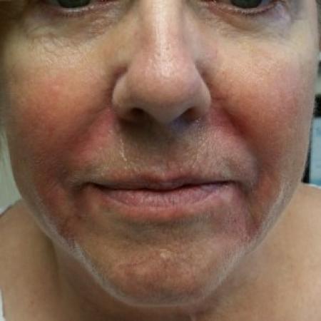 After image 1 Case #82381 - Juvederm for smile lines