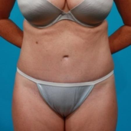 After image 1 Case #78856 - Abdominoplasty & Flank Liposuction