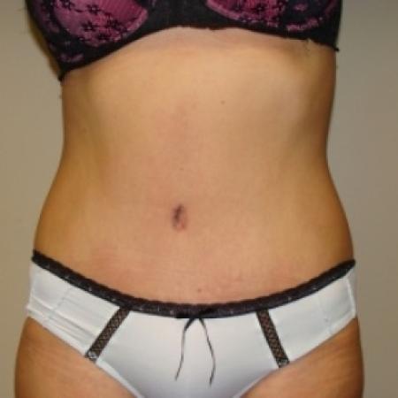 After image 1 Case #80116 - Abdominoplasty