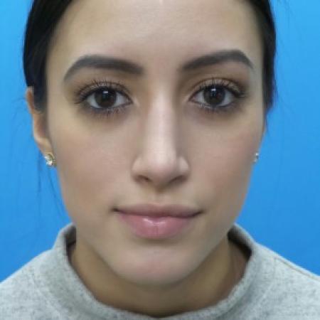 After image 1 Case #87301 - 23-year old - Open Rhinoplasty - 3 months post-op