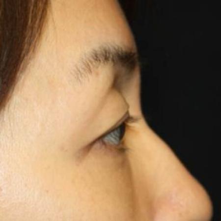 After image 3 Case #85586 - Blepharoplasty - Lower Lids Only - 43 year old female