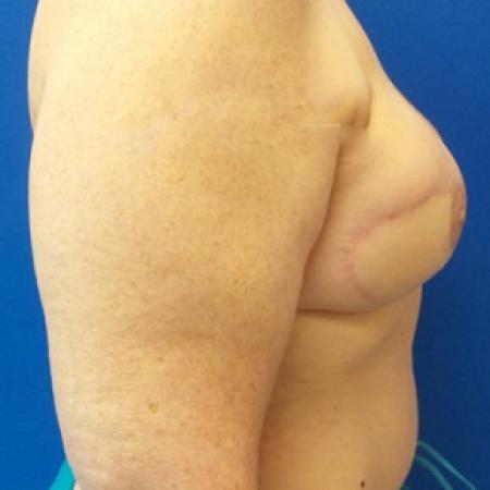 After image 2 Case #87631 - DIEP Flap Breast Reconstrution