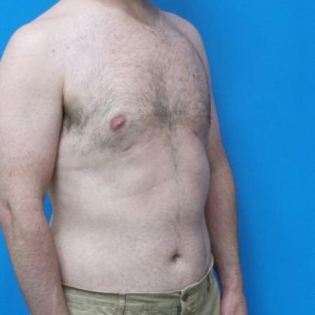 After image 2 Case #87421 - 45 year-old  -  Liposuction to Chest with Renuvion (SkinTite) /Liposuction to Lateral Flanks - 4 months post-op