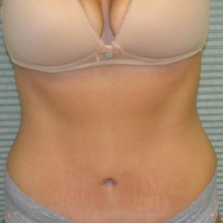 After image 1 Case #87836 - Tummy Tuck and liposuction of flanks