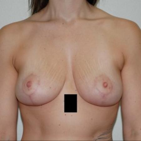 After image 1 Case #84631 - Breast Lift
