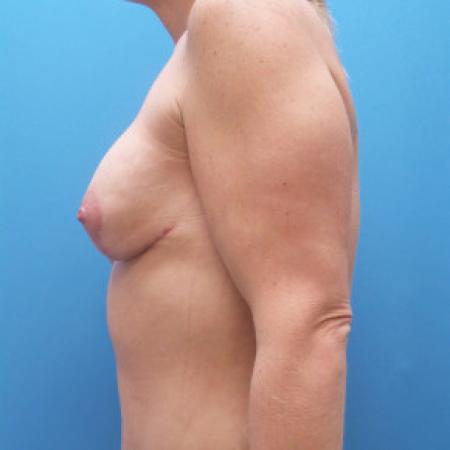 After image 3 Case #88311 - 33 year old - Breast Implant Exchange with mastopexy