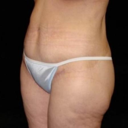 After Case #80256 - Lower Body Lift / Inner Thigh Lift
