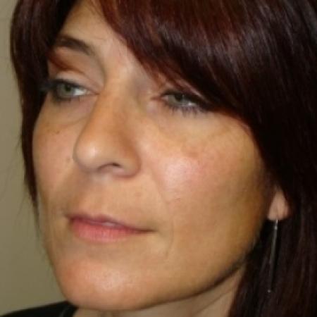 After image 2 Case #79556 - Rhinoplasty