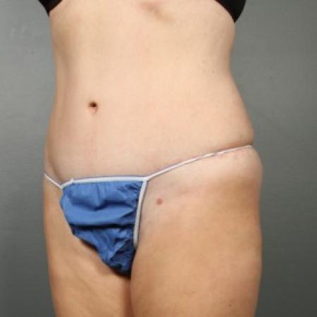 After image 2 Case #83611 - Liposuction Hips