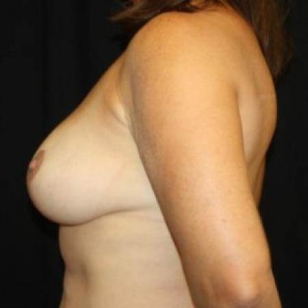 After image 3 Case #83746 - Breast Reduction - 48 year old female