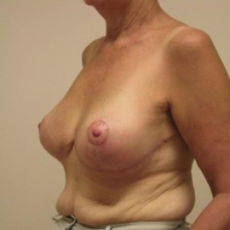 After image 3 Case #81106 - Breast Reduction