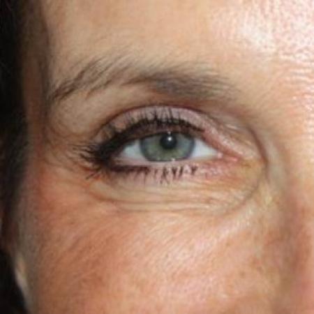 After image 3 Case #85301 - Botox (Glabella & Crows Feet) - 54 year old female.