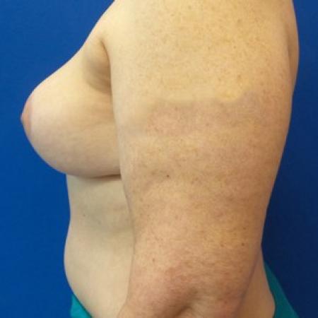 After image 3 Case #87631 - DIEP Flap Breast Reconstrution