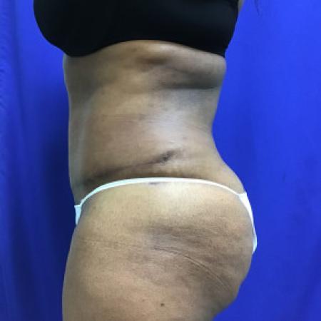 After image 3 Case #88281 - Tummy Tuck and Liposuction